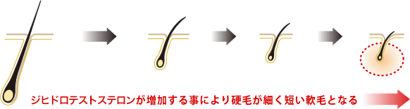 ジヒドロテストステロンが増加することにより硬毛が細く短い軟毛となる