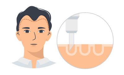 専用のパンチで毛根を採取していきます。採取した毛根は即座に冷却されます。